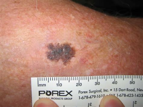 melanoma on back pictures